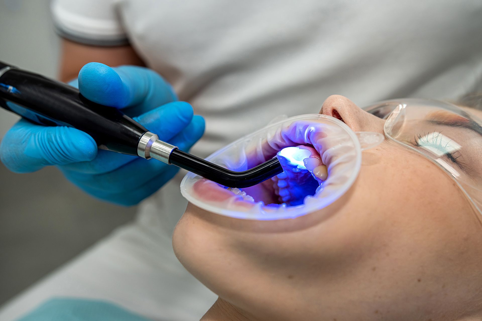 Dentist using a blue light curing device on a patient's teeth during a dental procedure. Dentist using a blue light curing device on a patient's teeth during a dental procedure.