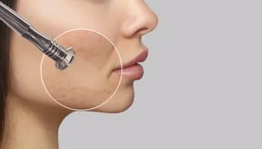Wange-einer-Frau-wird-mit-einer-Microdermabrasion-behandelt