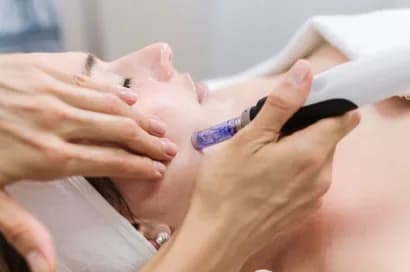 Haende-einer-Kosmetikerin-fuehren-Microneedling-bei-Patientin-im-Gesicht-durch