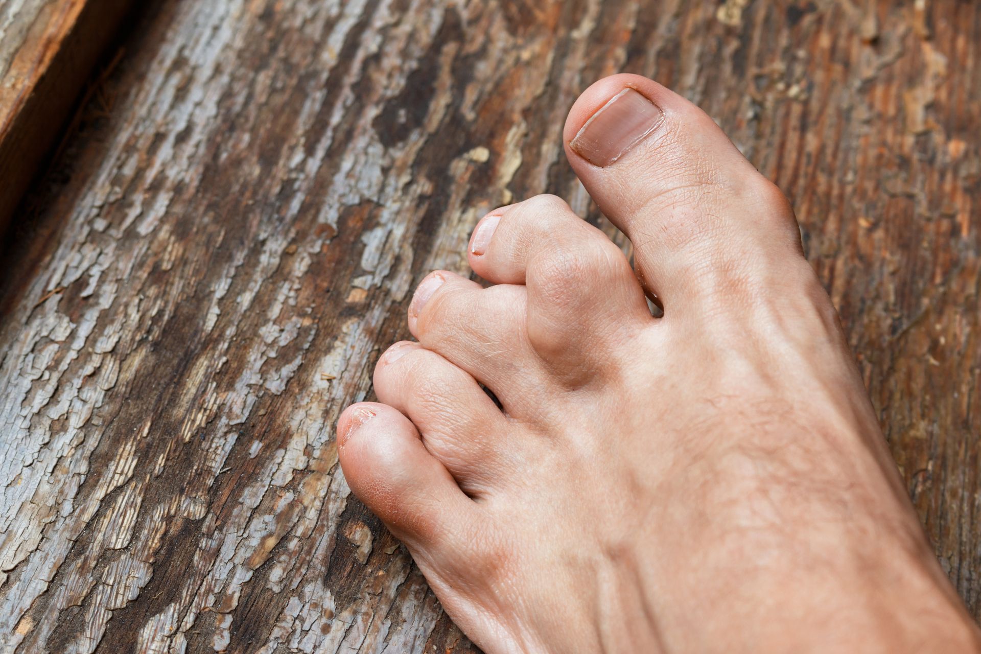 Foot with bunions on a textured wooden surface.