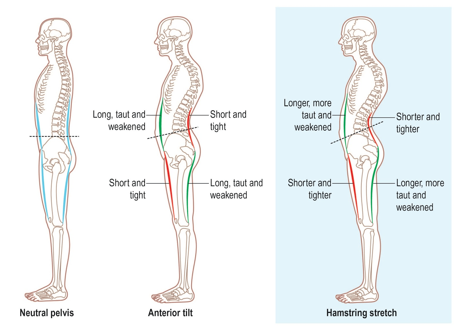 Side-view posture diagram comparing normal, rounded, and swayed standing alignment.