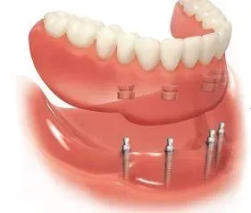 A Dental Bridge Is Being Built On A Model Of A Tooth — Port Denture Clinic In Port Macquarie, NSW