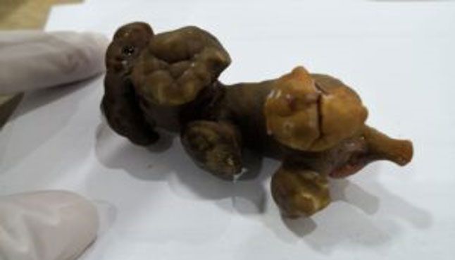Tratamiento de litiasis urinaria