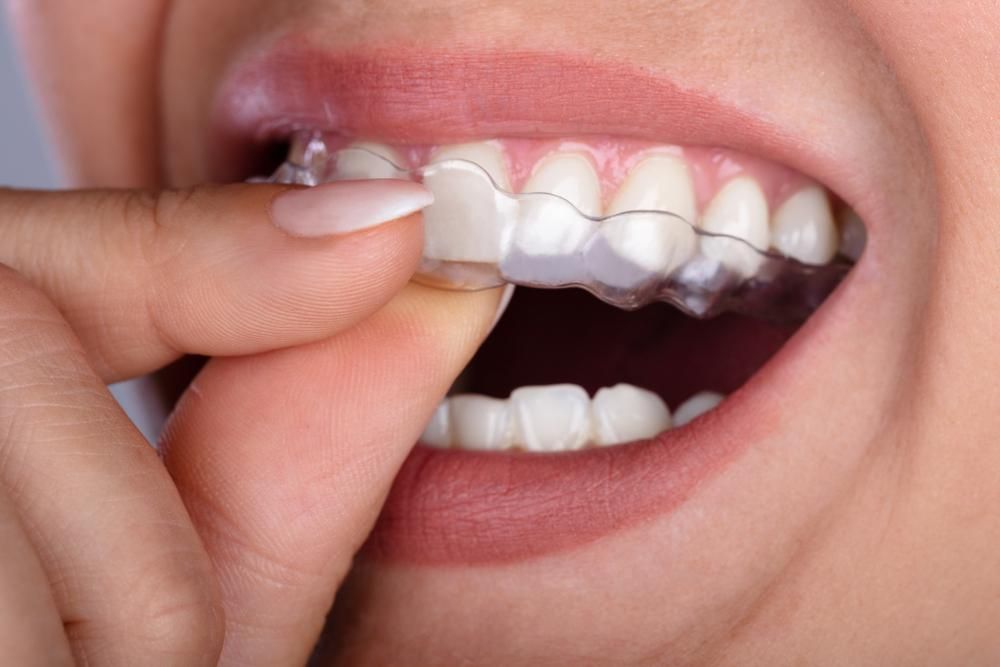 A Woman Is Putting a Clear Retainer on Her Teeth — Peter McLennan Denture Clinic in Grafton, NSW