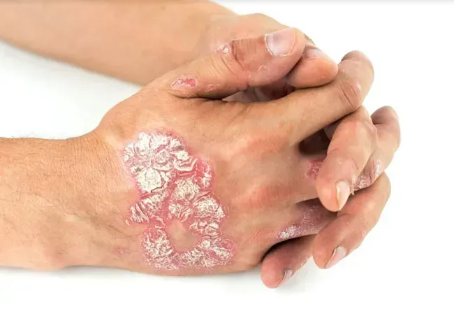 Itch happens, we've got you!
VIVAÉ® is ontstaan vanuit geloof in kracht van de natuur. Door alleen te werken met botanische extracten die waarde en verlichting toevoegen aan het product. Géén vulstoffen of parfums. 
