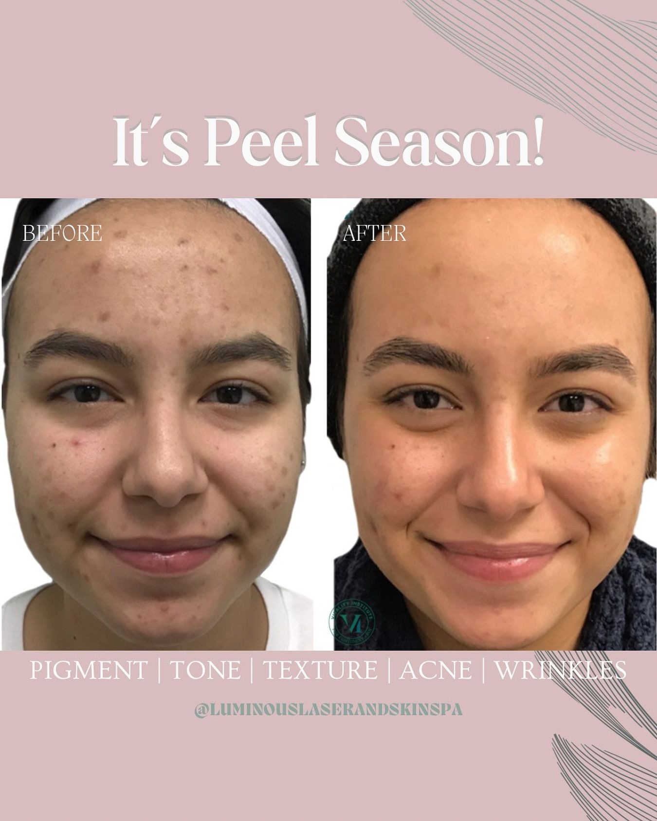A before and after photo of a woman 's face with acne and wrinkles.