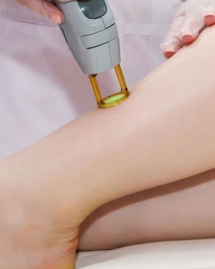 A woman is getting a laser hair removal treatment on her leg.