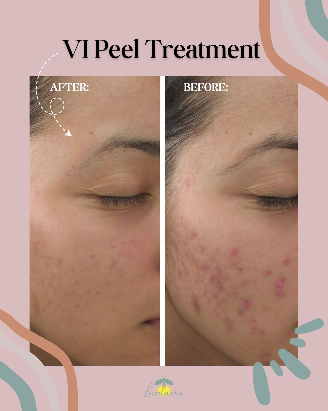 A woman 's face before and after a vi peel treatment