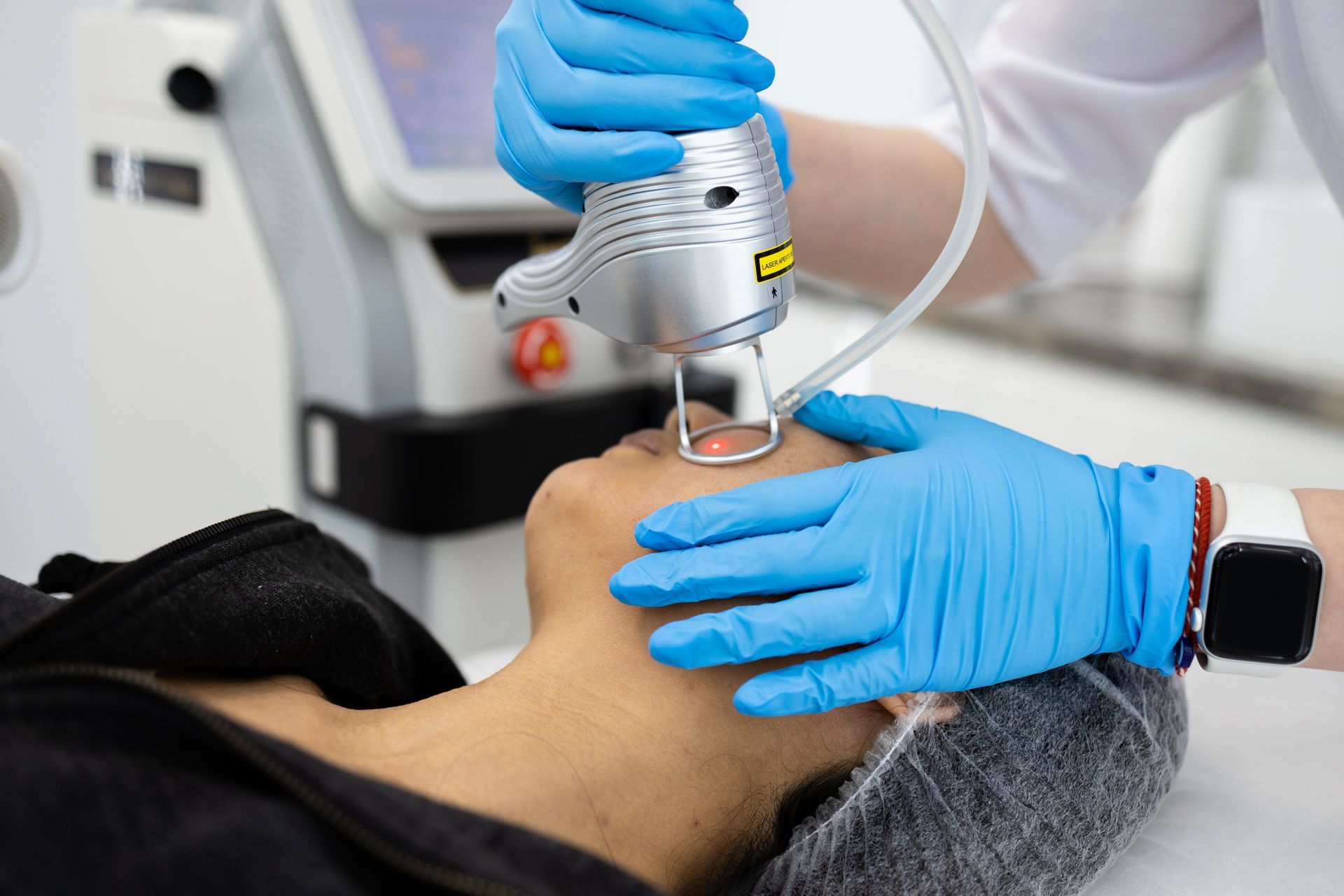 A woman getting the ablative CO2 laser on her face.