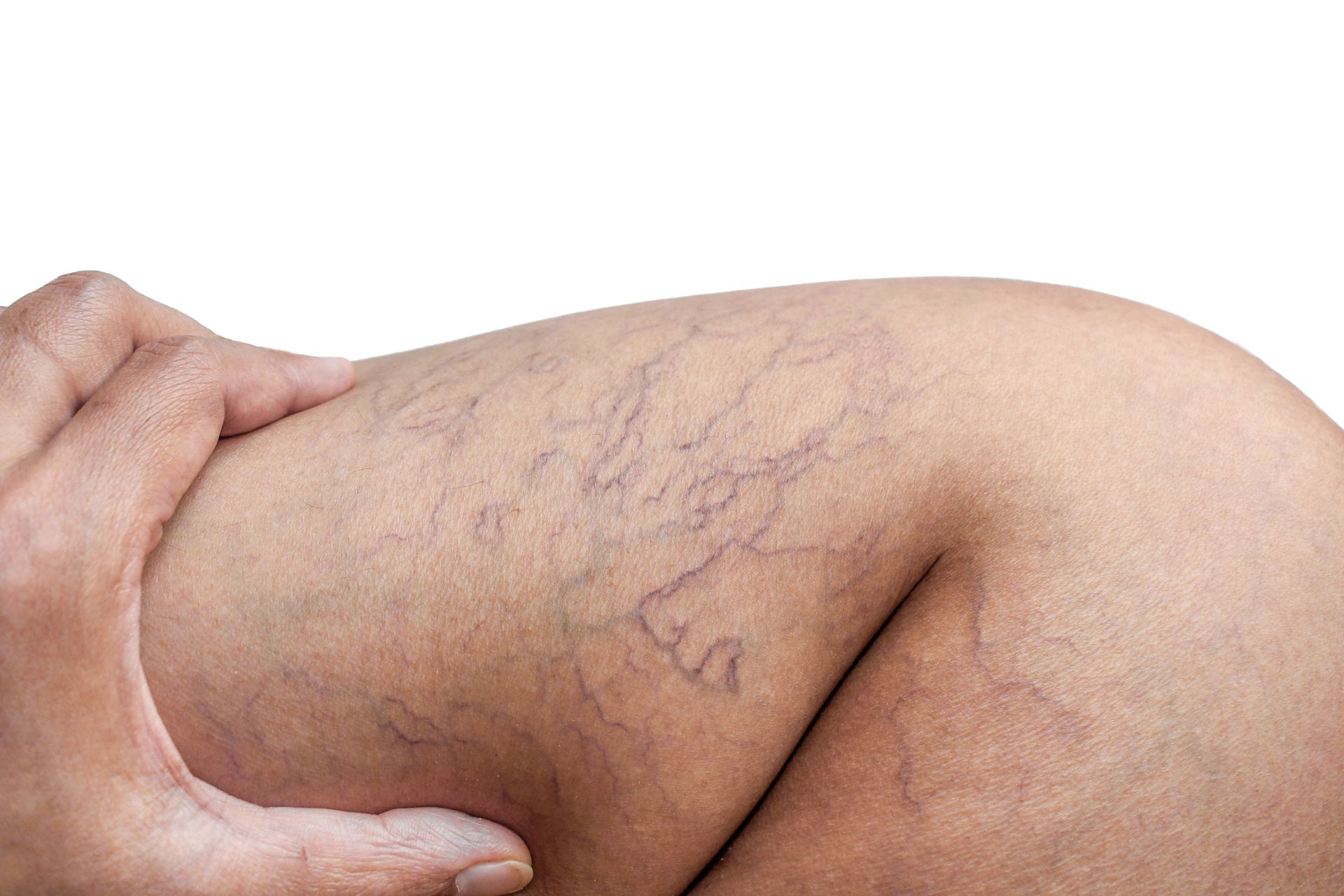 A person's leg with spider veins.