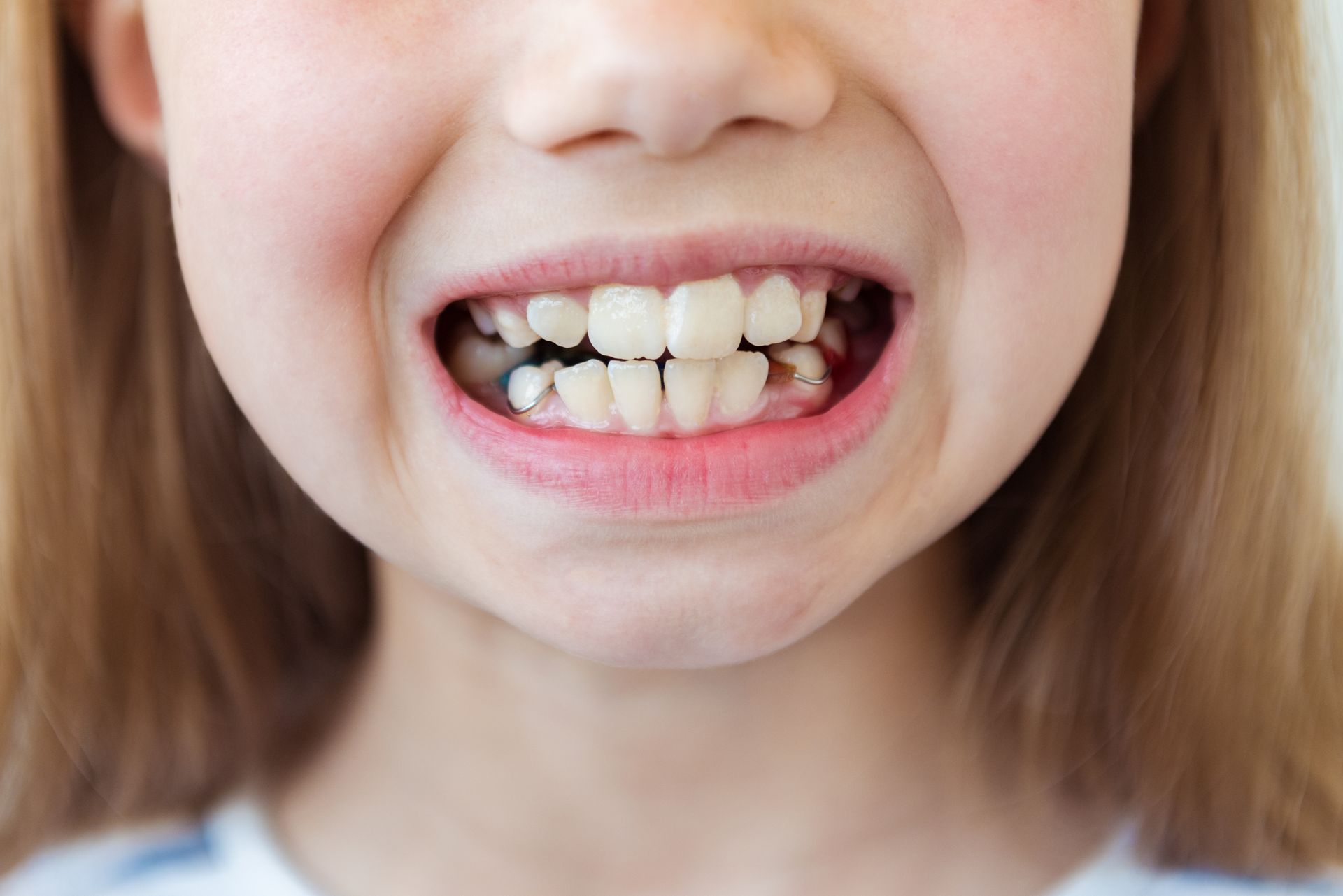 Close-up of a child smiling, showing crooked front teeth and gaps in the mouth