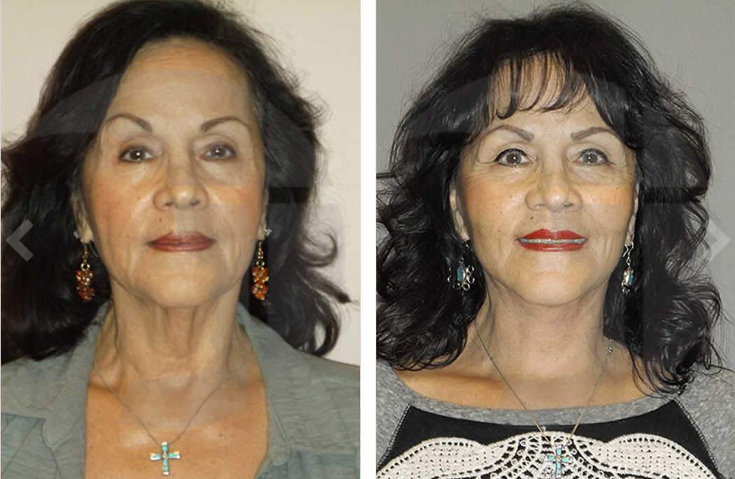 Side-by-side photos of a woman before and after a cosmetic procedure, showing a smoother neck.