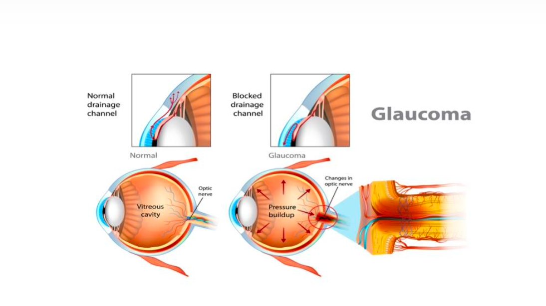 A diagram showing a healthy eye with a clear drainage channel next to an eye with blocked drainage and glaucoma.