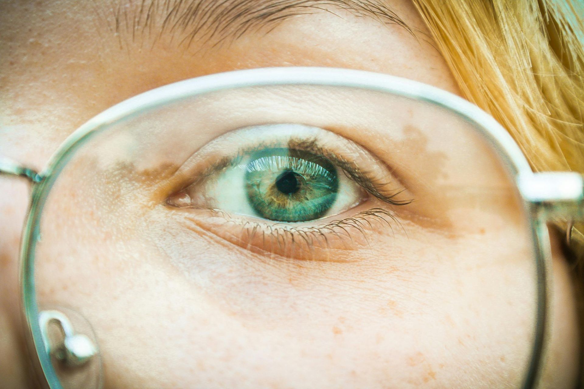 A close-up of a green eye seen through a lens, showing a prominent brown nevus on the iris and surrounding eyelid.