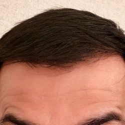 PRP hair restoration before and after photo at Longevity 360 Med Spa Newark DE