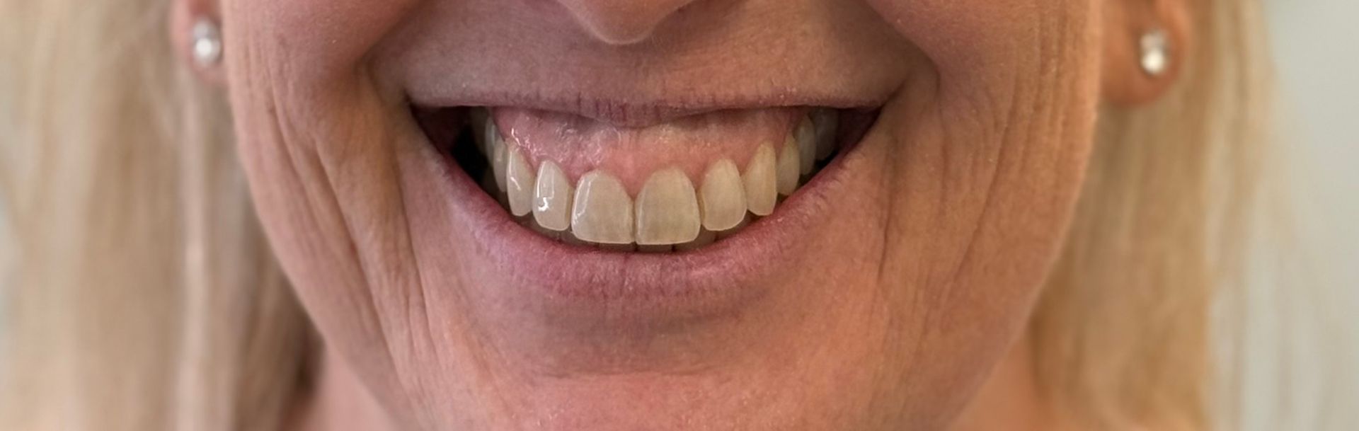 Before and after photo oPatient consultation icon for performance and recovery programs at Longevity 360f aesthetic treatment results at Longevity 360 Med Spa