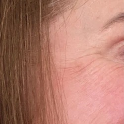 Before and after photo of hair restoration treatment at Longevity 360 Med Spa