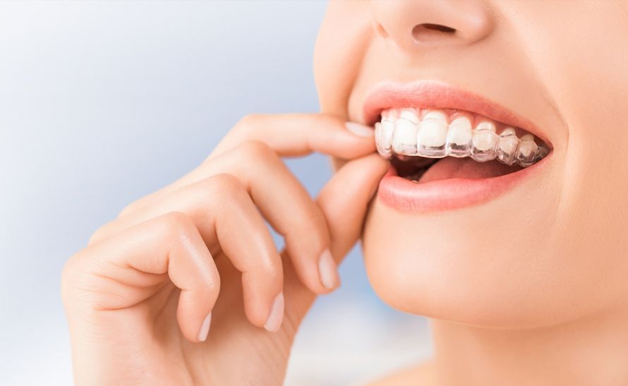 What Happens After the Last Invisalign Tray