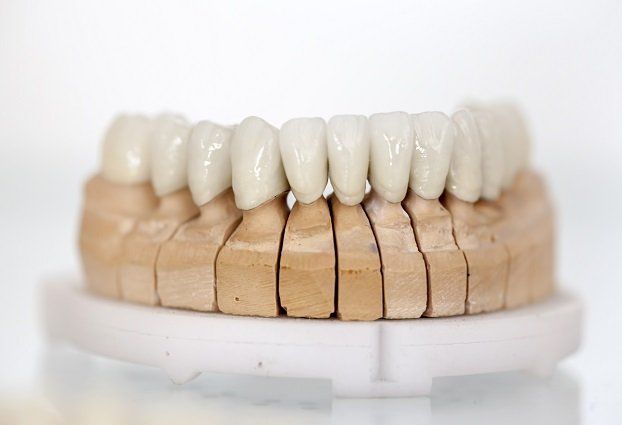 Dental Veneers Glenview Dental Veneers Glenview