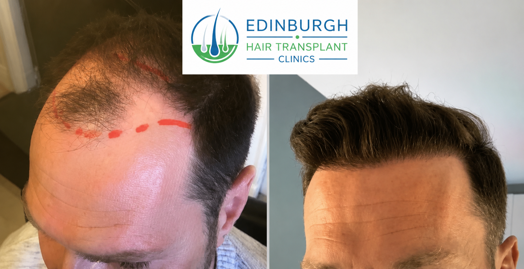 Temple hair transplant result