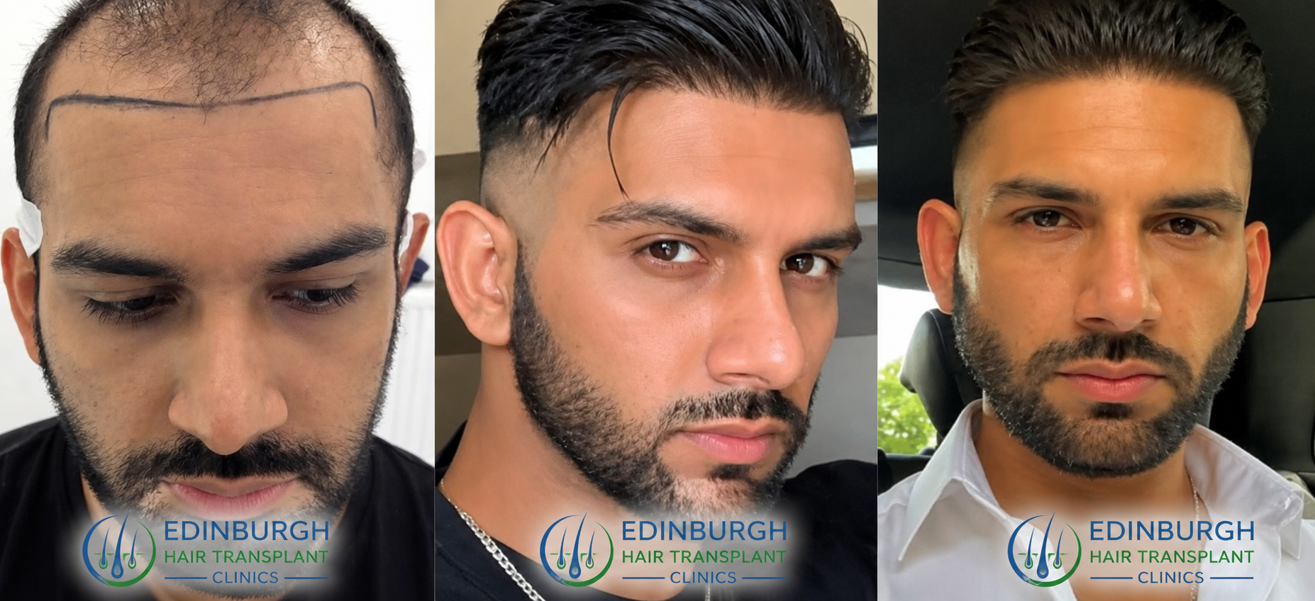 FUE patient result
