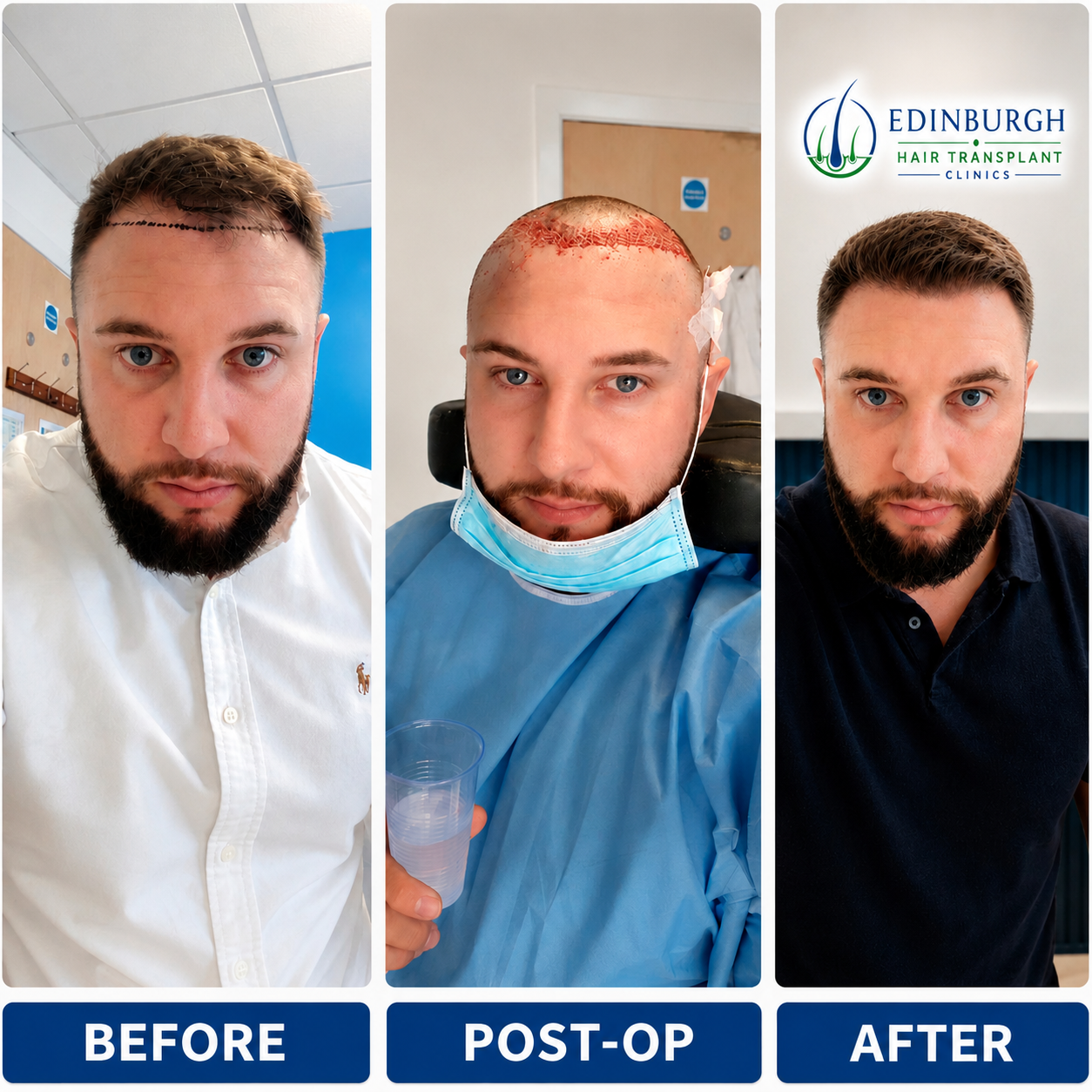 Widow’s peak hair transplant before treatment, immediately after treatment and after hair growth