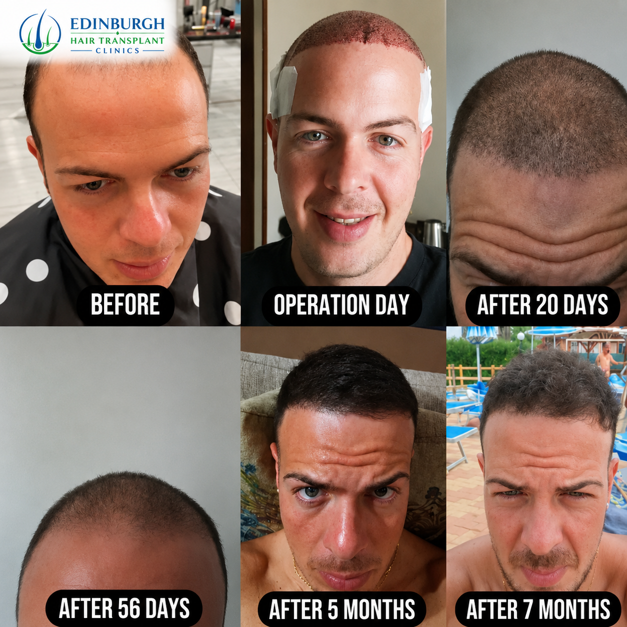 Male hairline transplant progress timeline
