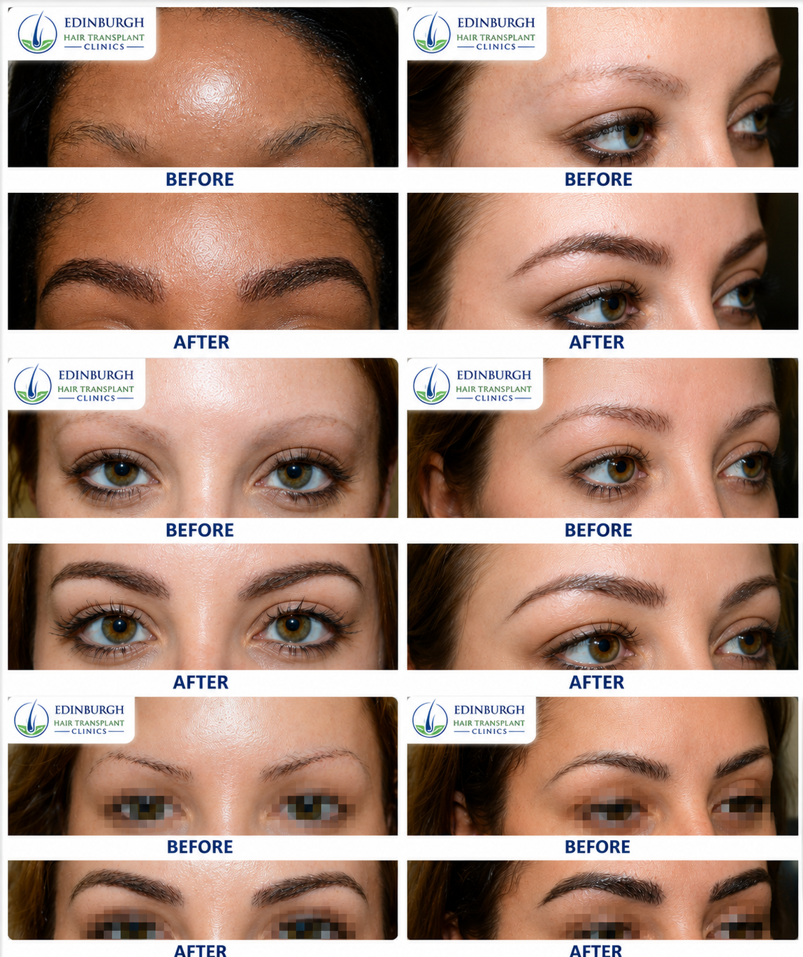 Eyebrow transplant before and after result