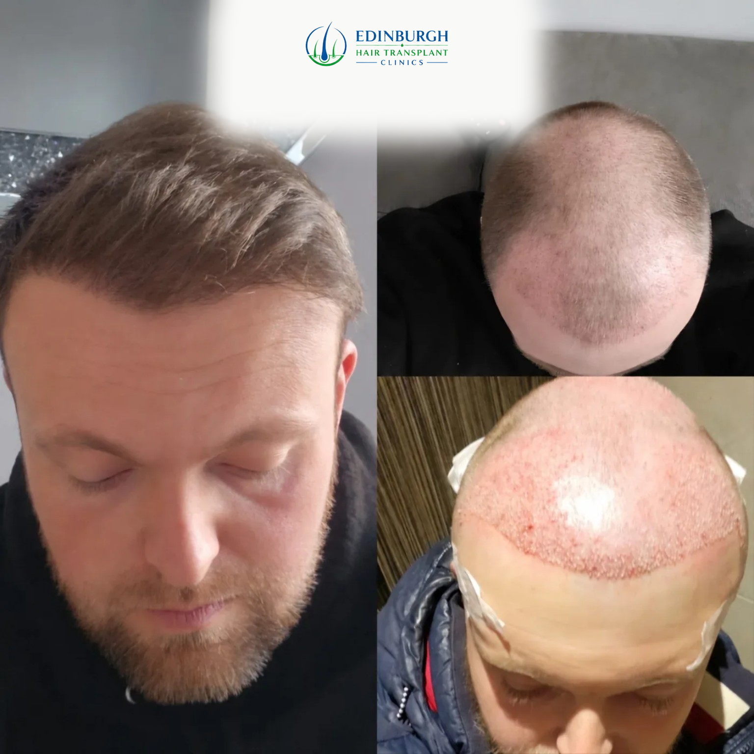 Hair transplant before and after result