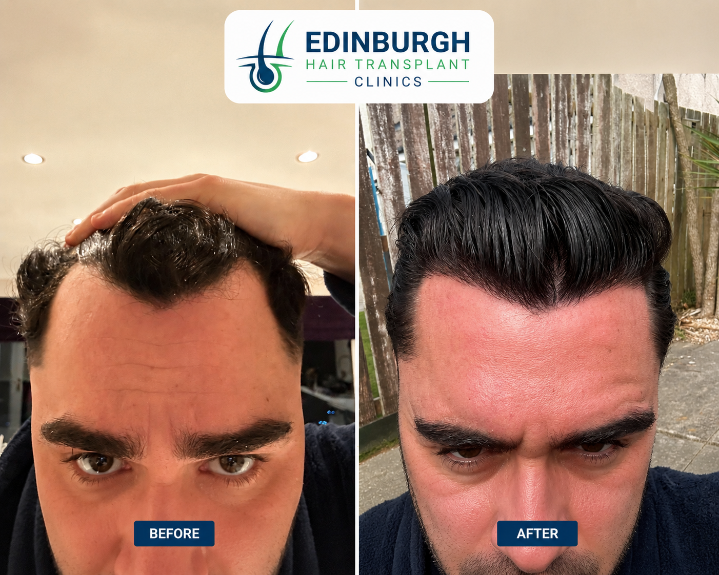 Hair transplant before and after result at Edinburgh Hair Transplant Clinics