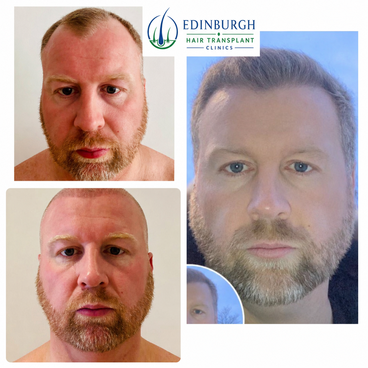 Male hairline transplant before treatment and later result