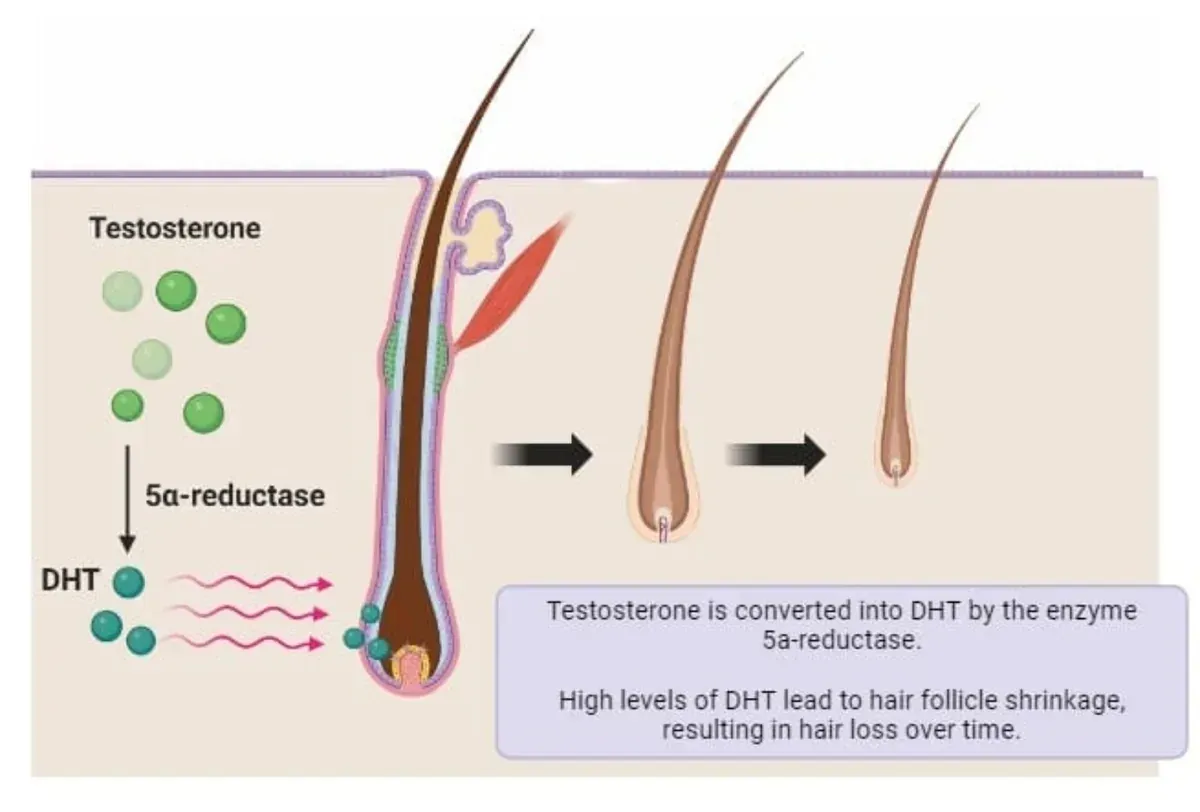 Illustration showing DHT-related hair follicle miniaturisation