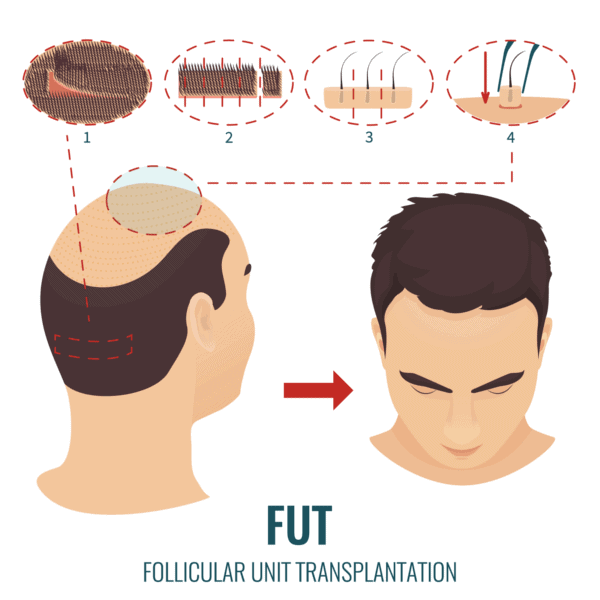 FUT hair transplant strip removal and graft implantation process