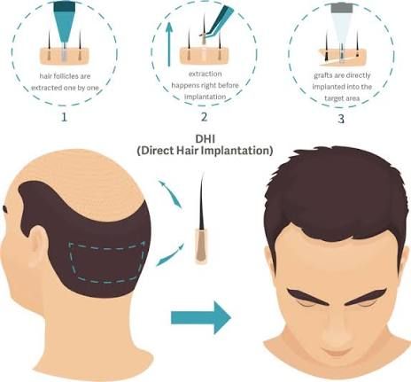 DHI hair transplant extraction and implantation process