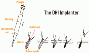 Hair transplant procedure illustration