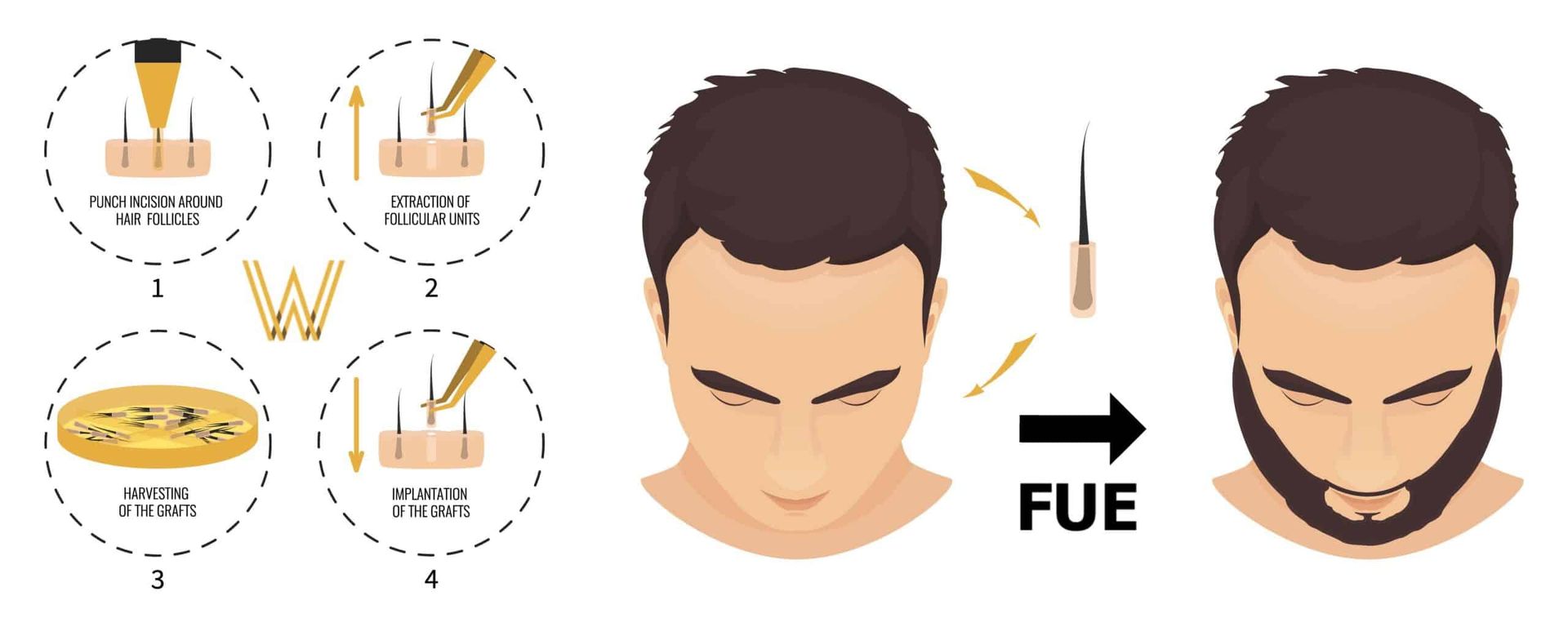 Illustration showing FUE extraction and beard implantation