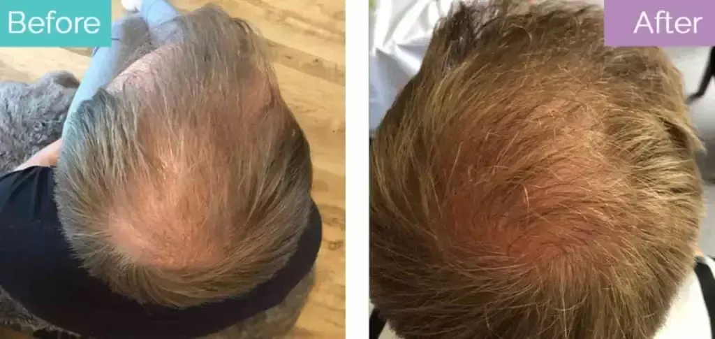 Crown hair transplant before and after result