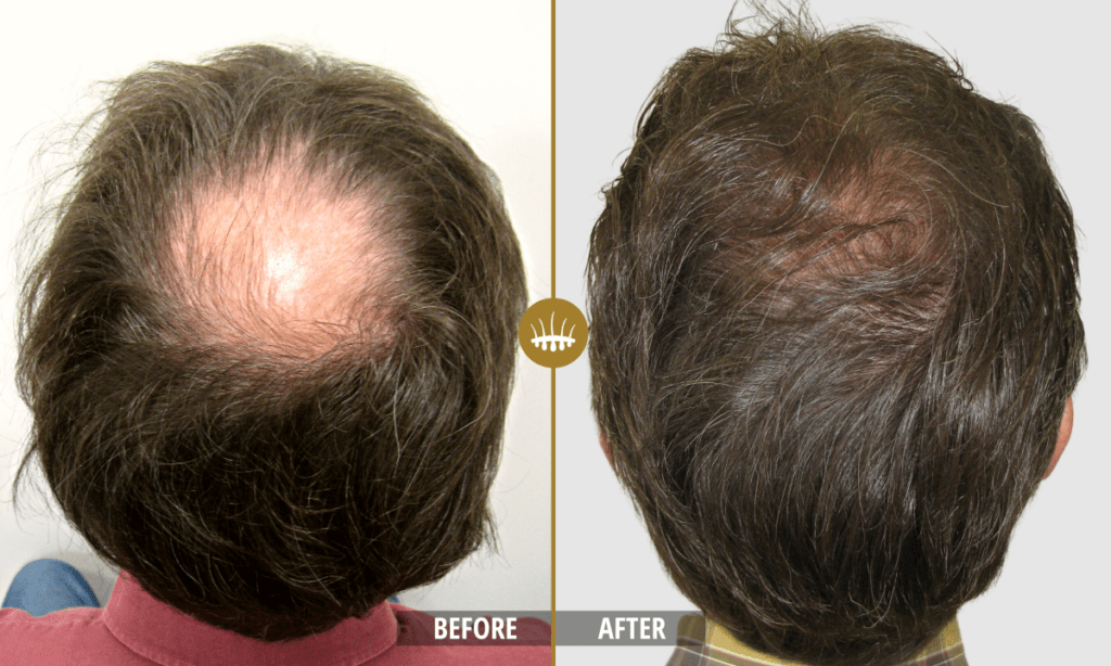 Crown hair transplant result