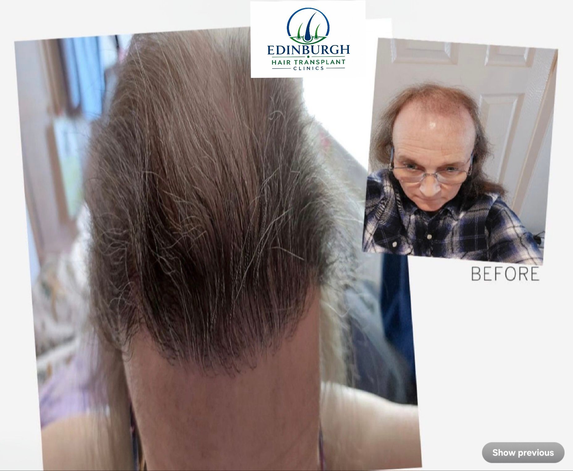 Transgender hair transplant before and after result