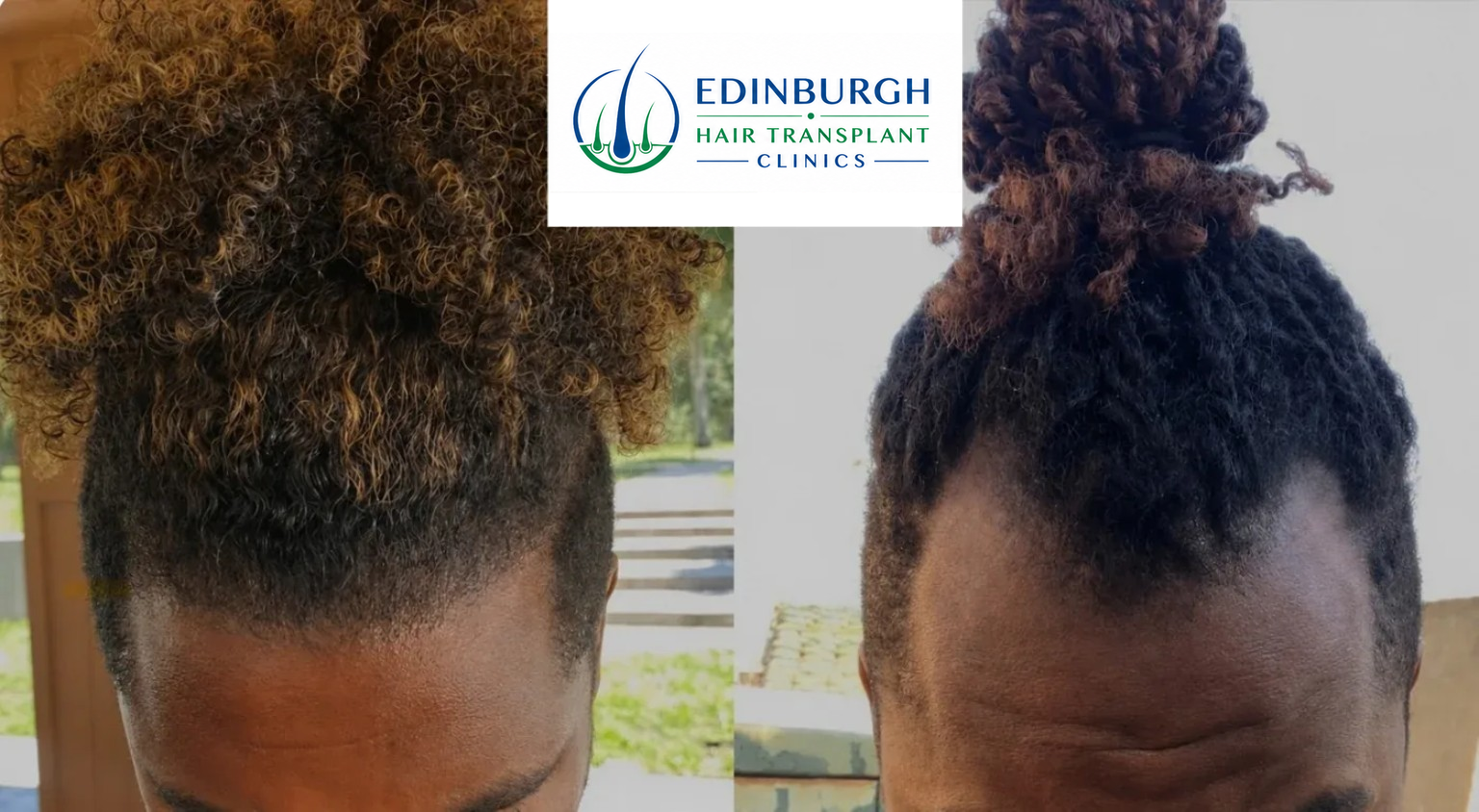 Afro hair transplant case study showing frontal hairline and density restoration