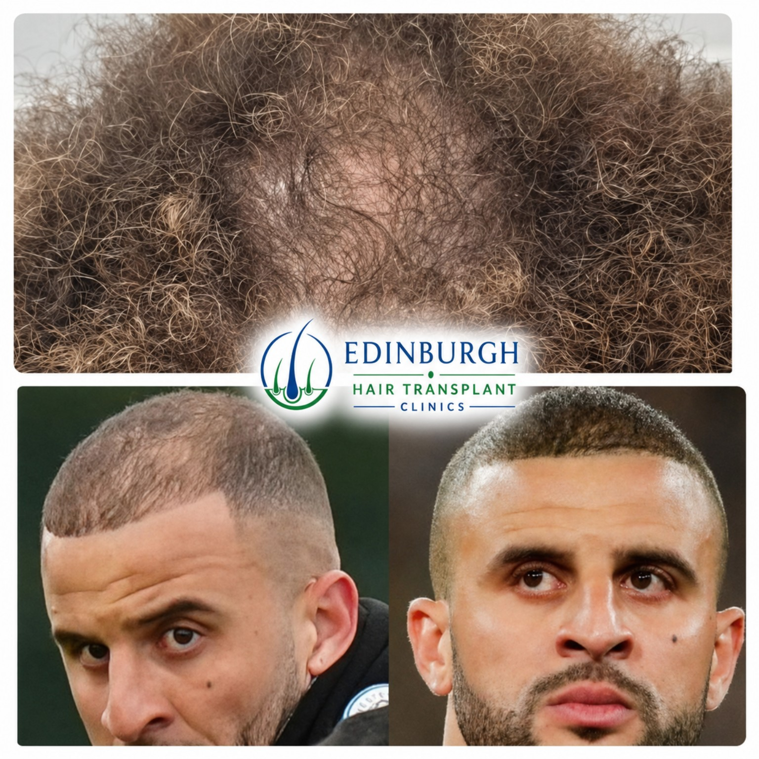 Afro hair transplant patient result