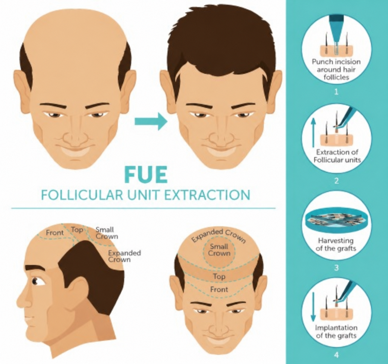 FUE hair transplant illustration showing follicular unit extraction and implantation