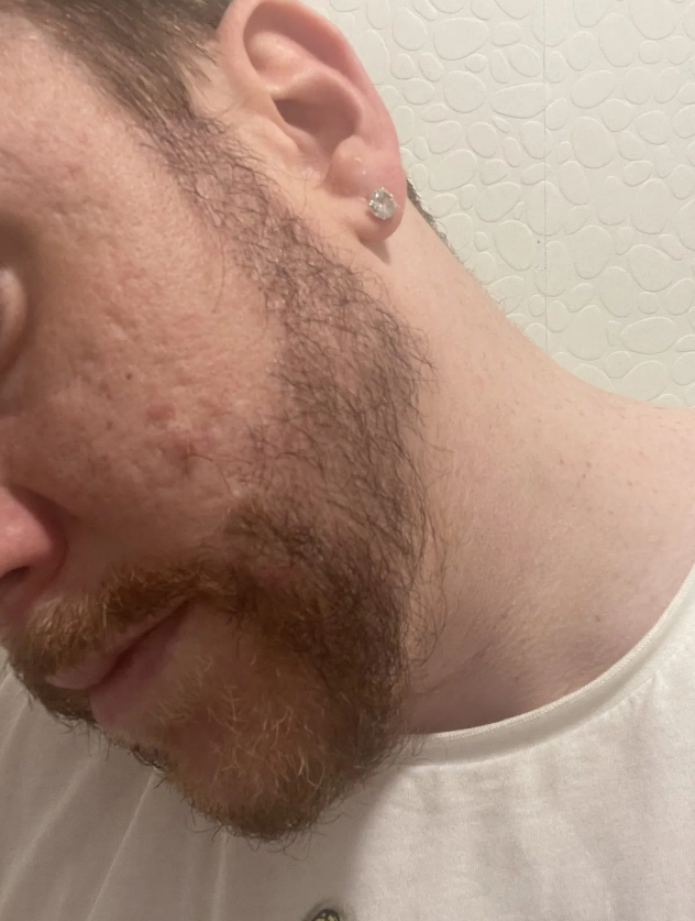 Left side beard hair transplant patient result