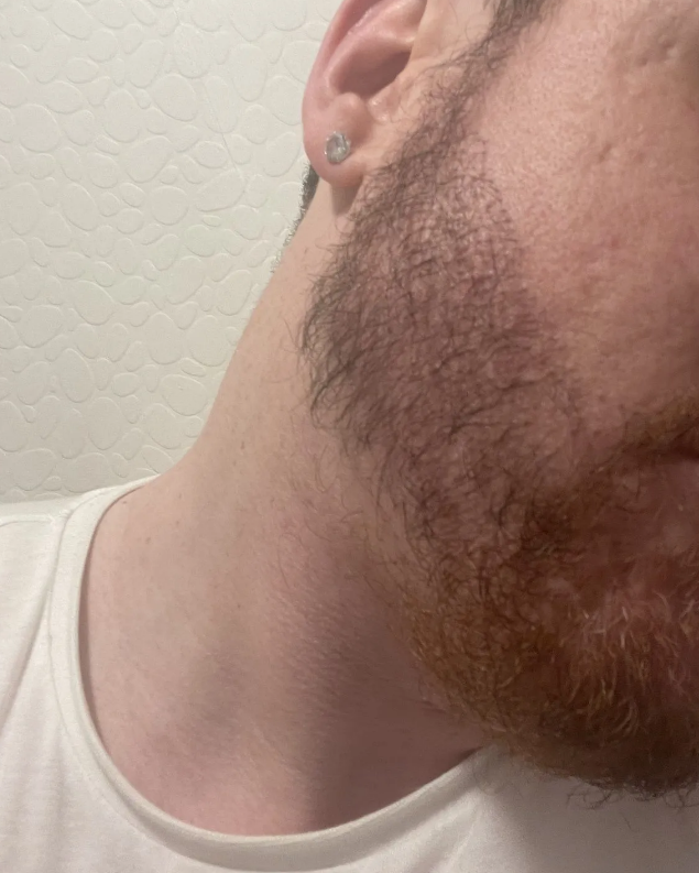 Right side beard hair transplant patient result