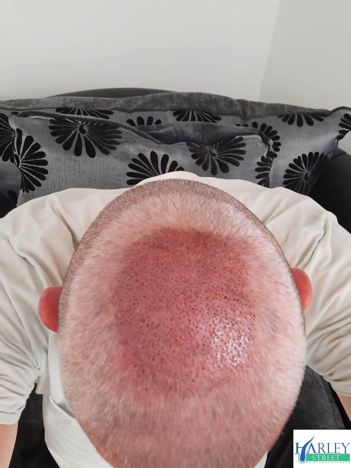 Crown hair transplant before treatment