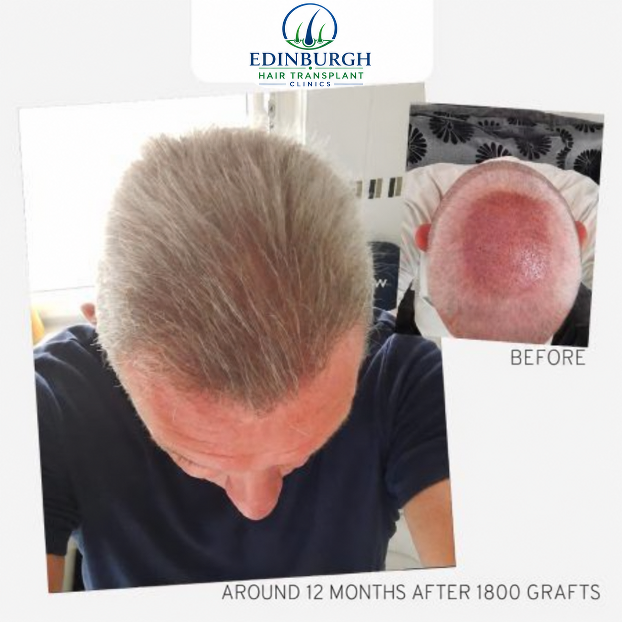 Andy, age 53: FUE crown transplant with 1,800 grafts, result at around 12 months