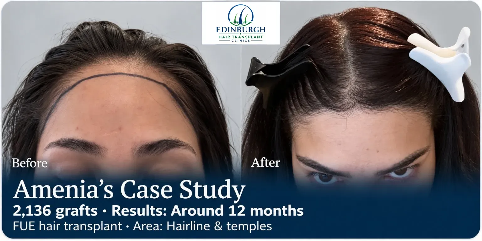 Amenia: FUE, Hairline and temples, 2,136 grafts, results at 12 months