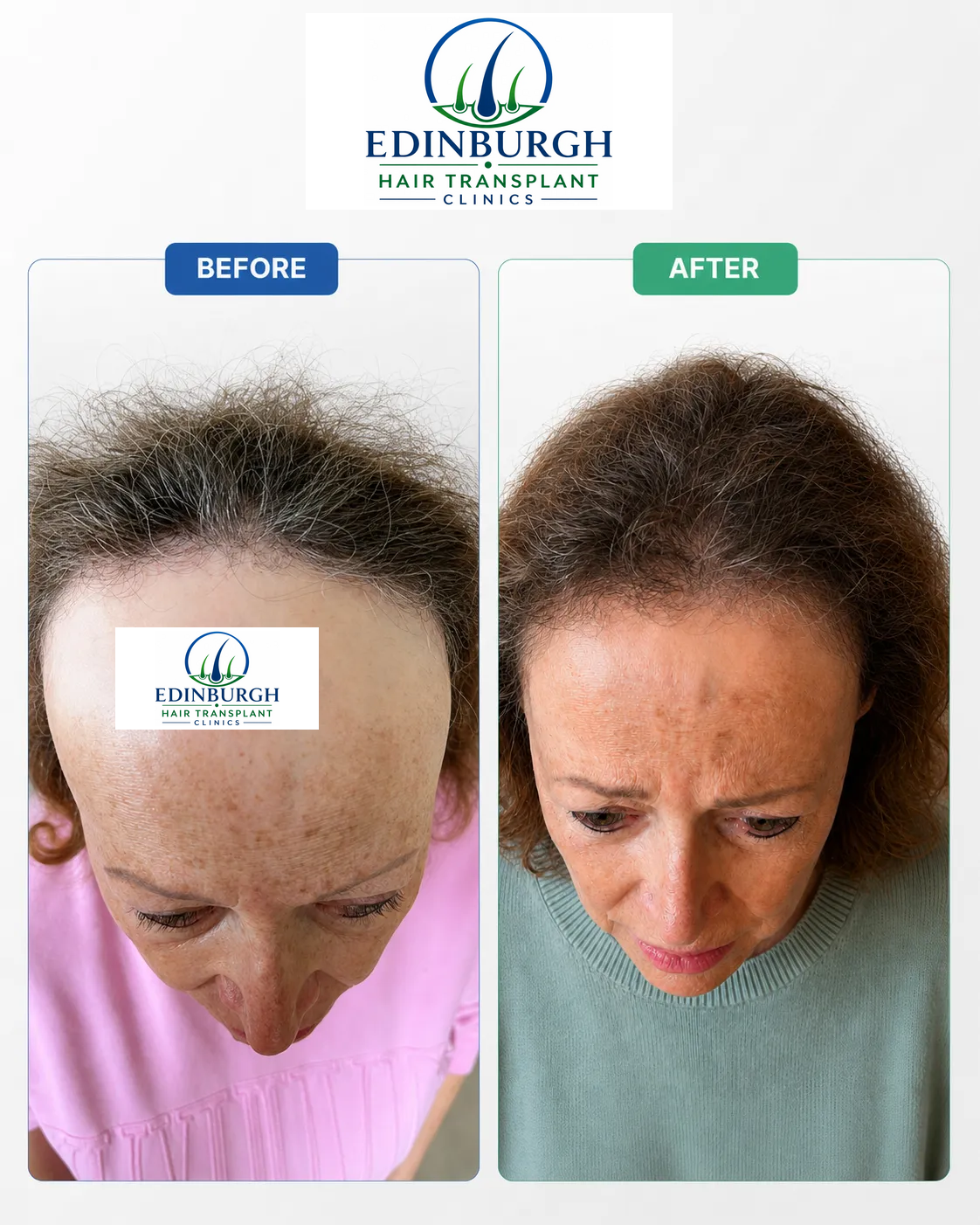 Amy hair transplant before and after comparison