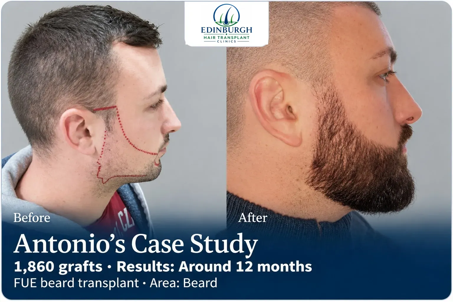 Antonio: FUE beard transplant, Beard, 1,860 grafts, results at 12 months