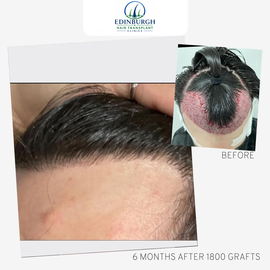 Benjamin hair transplant before and after comparison